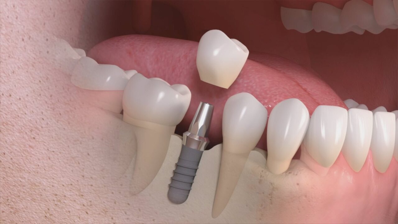 Implante dental unitario - PGP Odontología