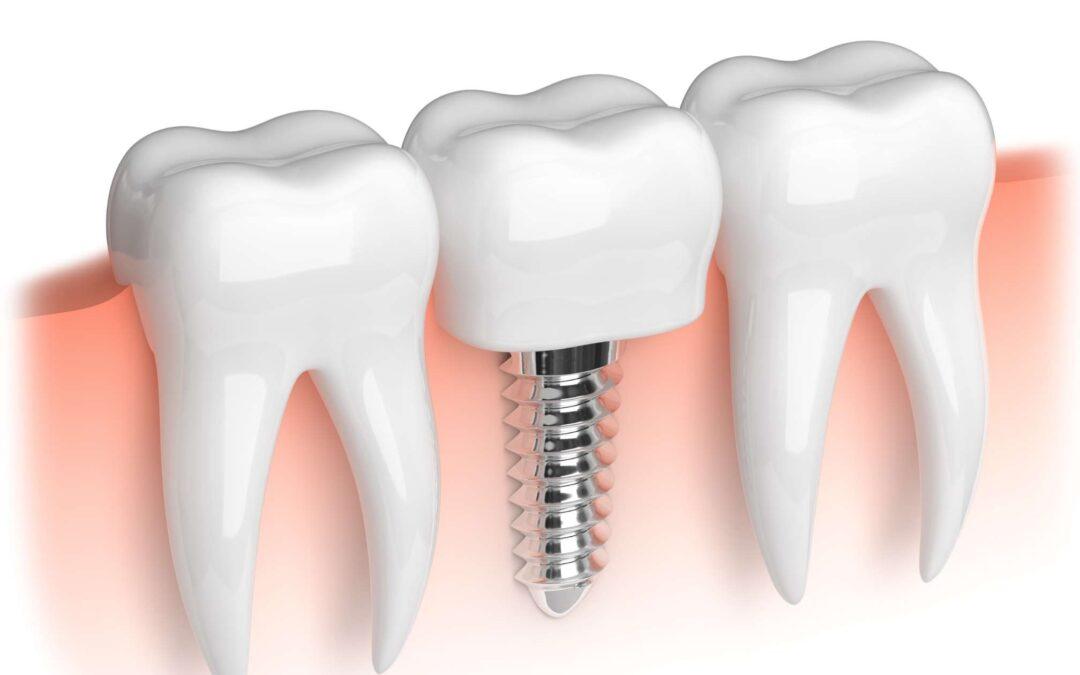 Implantes dentales para preservar el hueso